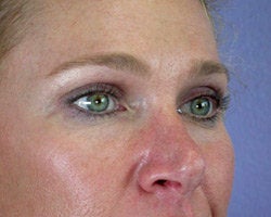 Eyelid Surgery