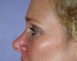 Eyelid Surgery