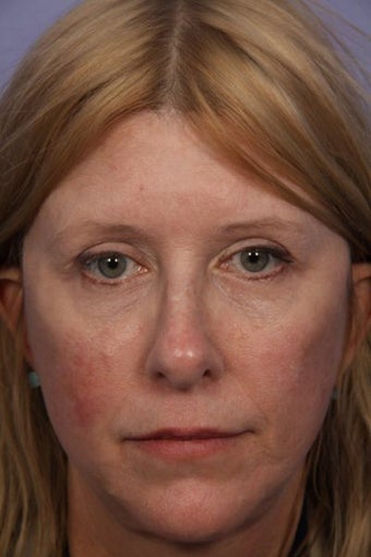 Eyelid Surgery