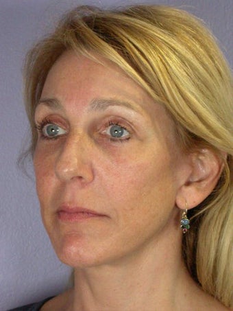 Eyelid Surgery
