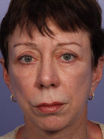 Eyelid Surgery 