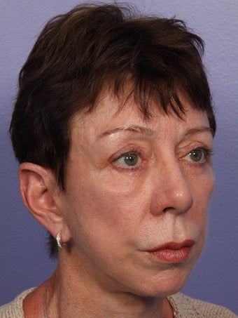 Eyelid Surgery