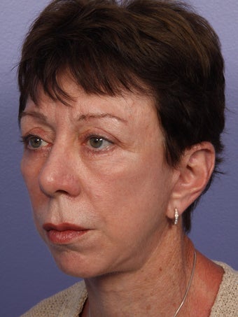Eyelid Surgery