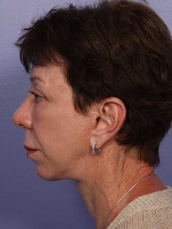Eyelid Surgery
