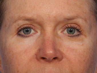 Eyelid Surgery