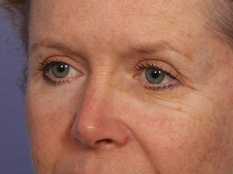 Eyelid Surgery