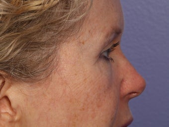 Eyelid Surgery