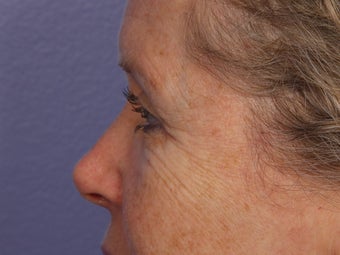 Eyelid Surgery