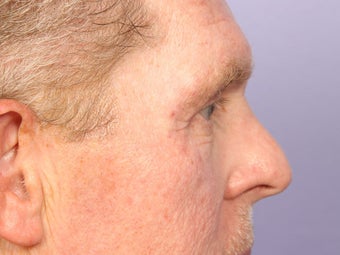 Eyelid Surgery