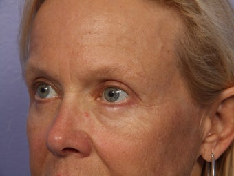 Eyelid Surgery