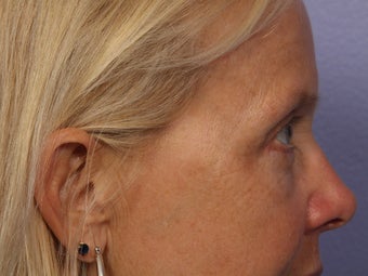 Eyelid Surgery 