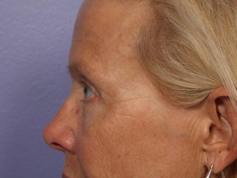 Eyelid Surgery