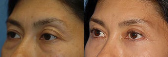 Blepharoplasty-Mid-Face