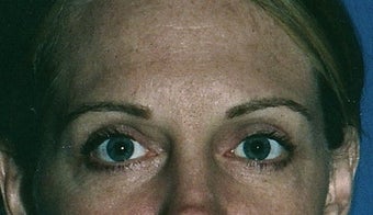 Upper and lower eyelid (blepharoplasty) Surgery
