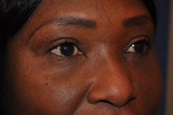 Blepharoplasty (Upper and Lower eyelids)