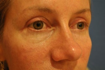 Blepharoplasty (Upper eyelids)
