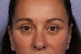 Eyelid Surgery 