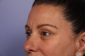 Eyelid Surgery 