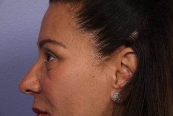 Eyelid Surgery 