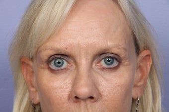 Eyelid Surgery