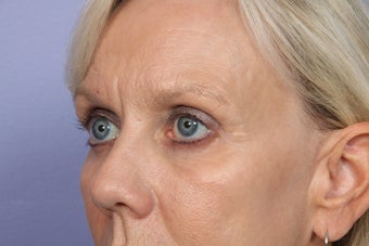 Eyelid Surgery
