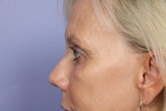 Eyelid Surgery