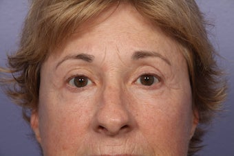 Eyelid Surgery
