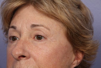 Eyelid Surgery