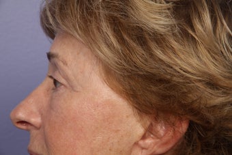 Eyelid Surgery