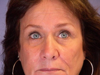 Eyelid Surgery