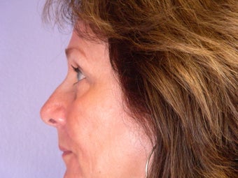 Eyelid Surgery