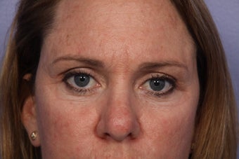 Eyelid Surgery