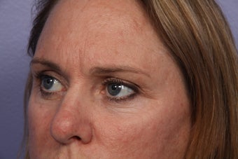 Eyelid Surgery