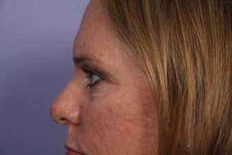 Eyelid Surgery
