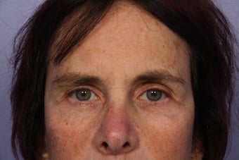 Eyelid Surgery 