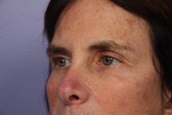 Eyelid Surgery 