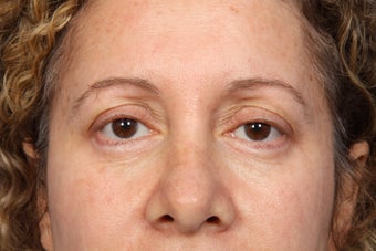 Eyelid Surgery 