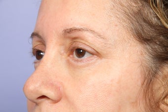 Eyelid Surgery 