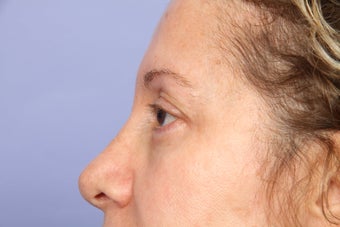 Eyelid Surgery 