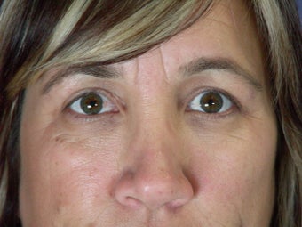 Eyelid Surgery 