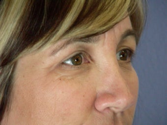 Eyelid Surgery 