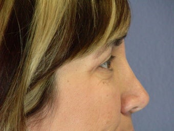 Eyelid Surgery 