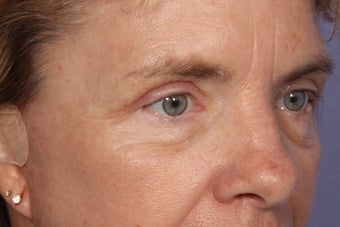 Eyelid Surgery