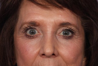 Eyelid Surgery