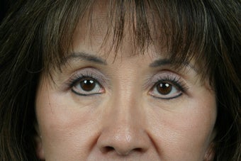 Eyelid Surgery