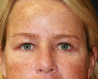 Blepharoplasty