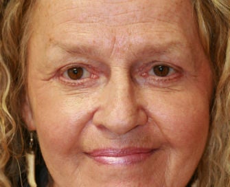 Upper Eyelid Blepharoplasty and Corner of Lip Lift
