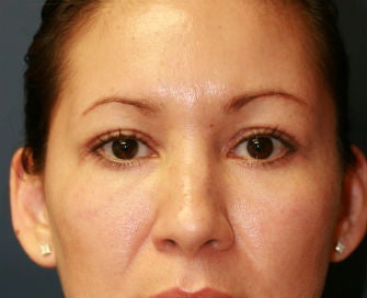 Upper and Lower Eyelid Blepharoplasty