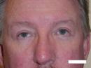 Eyelid Surgery (Blepharoplasty)