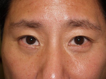 Lower Lid Blepharoplasty